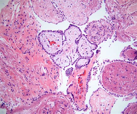 Pathology Outlines Well Differentiated Papillary Mesothelioma