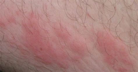 Stress Rash Causes Symptoms Pictures And Treatment Hubpages