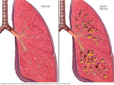 Cystic Fibrosis Disease Reference Guide Drugs Com