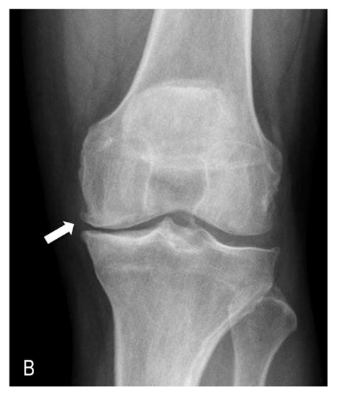 Knee Osteoarthritis A Primer The Permanente Journal
