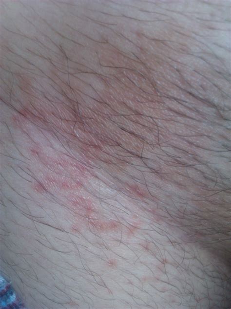 I Have A Rash In My Groin That Wont Go Away Its Been Almost