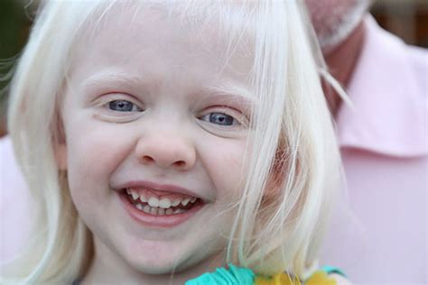 Albinism As Related To Down Syndrome Pictures