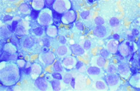 Histiocytic Lymphoma Presenting As A Testicular Tumour And Terminating