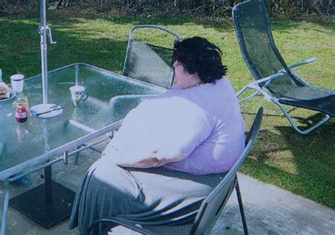 Weight Loss Morbidly Obese Gran Drops Stone With Gastric Sleeve