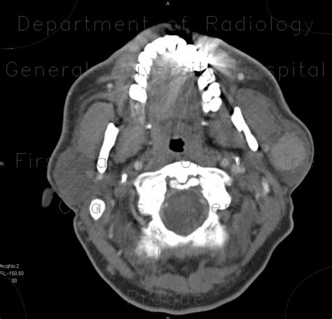 Radiology Case Warthin Tumor Parotid Gland