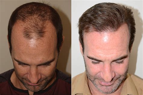 Hair Transplants For Men Photos Miami Fl Patient