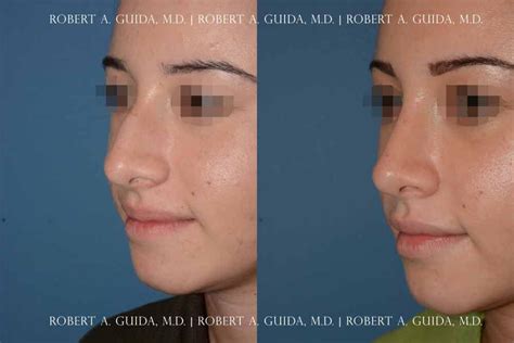 Ways To Fix A Deviated Septum Without Surgery Earth Base