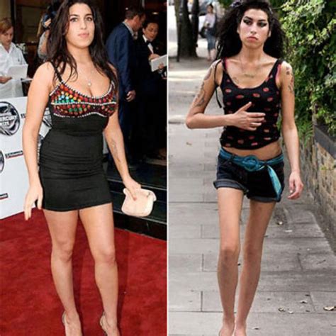 anorexia celebrities with anorexia nervosa