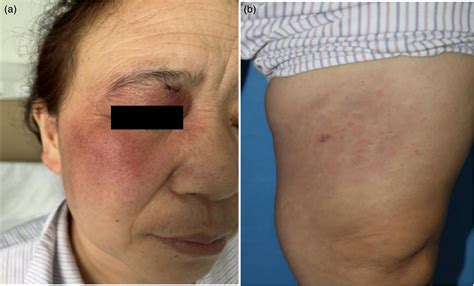 A Case Of Lupus Erythematosus Tumidus Misdiagnosed As Erysipelas Qing