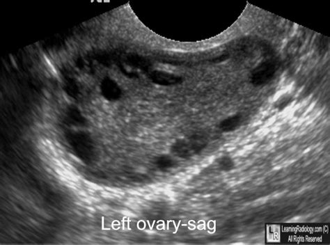 And a visual assessment of the pelvis at either laparoscopy or. LearningRadiology - Polycystic, Ovary, Syndrome, PCOS ...