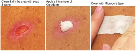 Skin Cancer Treatment 26 Curaderm Bec5 Eggplant Extract Cream