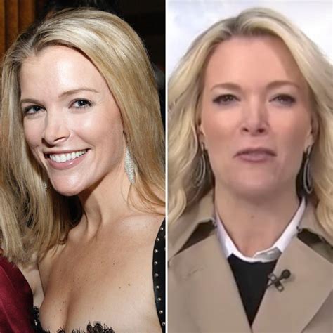 Has Tv Star Megyn Kelly Gotten Plastic Surgery Experts Weigh In