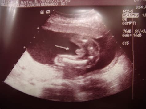 Natalies Pregnancy Blog 19 Weeks 6 Days Ultrasound Techs Are Sadists