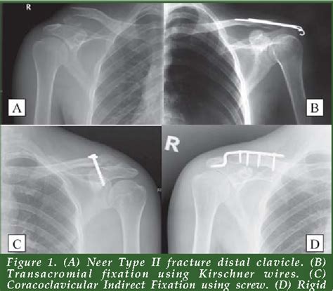 Figure 1 From Distal Clavicle Fractures And Acute Acromioclavicular