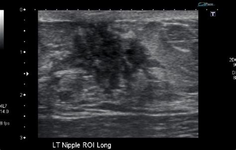 Gynaecomastia Ultrasoundpaedia