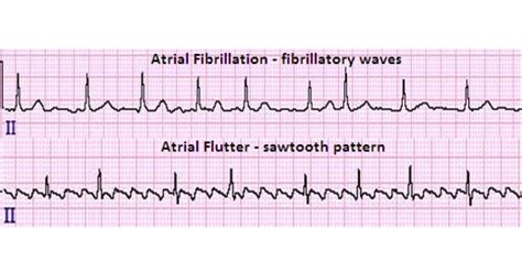 Video Atrial Flutter Vs Atrial Fibrillation