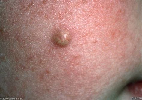 Epidermoid Cyst Pictures Photos