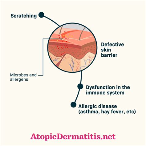 Why Does Atopic Dermatitis Itch Atopic Dermatitis Symptoms