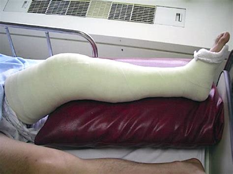 Cast Kit Long Leg Plaster A 1 Medical Integration