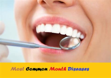 The 20 Most Common Mouth Diseases Speaky Magazine 2022