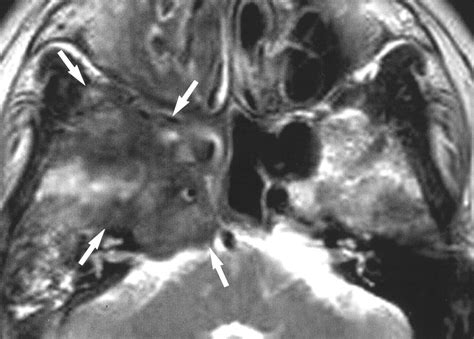 Cavernous Sinus Syndrome Clinical Features And Differential Diagnosis