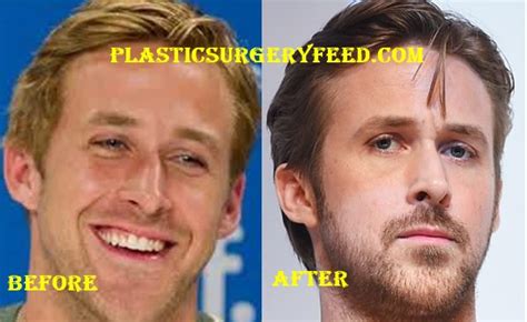 Ryan Gosling Plastic Surgery Plastic Surgery Feed
