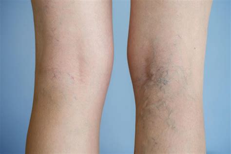 Varicose Veins How To Know If You Need A Varicose Veins Specialist’s Intervention