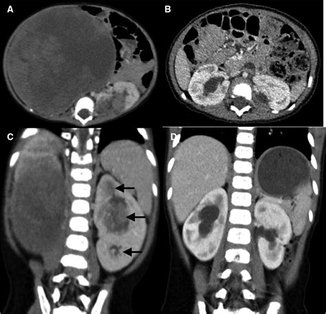 Abdominal Ct Scans Of Case 6 Ac Preoperative Ct Images Reveal A