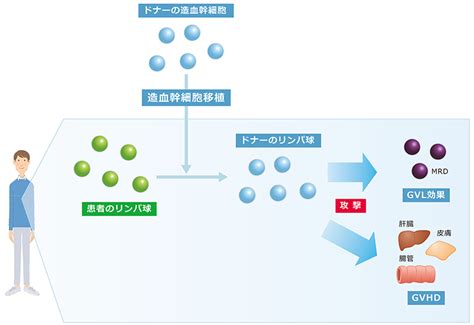 造血幹細胞移植｜治療｜急性リンパ性白血病基本情報｜メディカルスタッフ向け｜ビーリンサイトjp