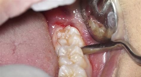 Estrazione Dente Del Giudizio Senza Dolore Dente Del Giudizio Denti