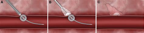 Vascular Closure Devices In Interventional Radiology Practice