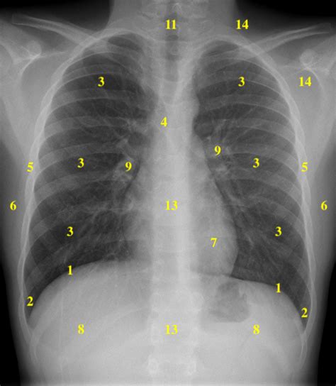 52 Approach To The Chest X Ray Cxr Medicine Libretexts