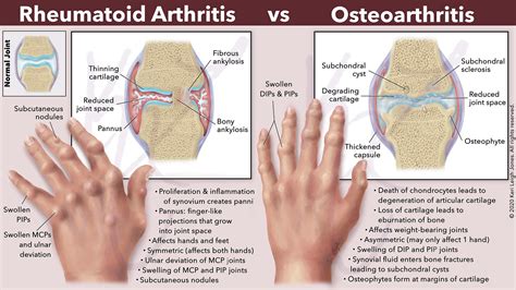 Rheumatoid Arthritis Vs Osteoarthritis Keri Leigh Biomedical Creations