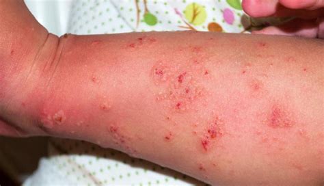 5 Skin Conditions That Look Like Eczema