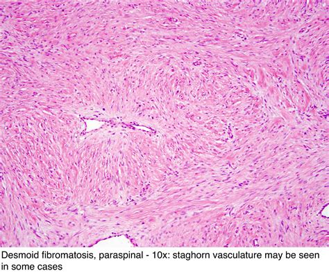 Pathology Outlines Fibromatosis Desmoid