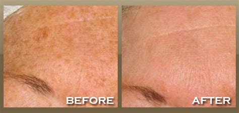 Ipl Photofacial Brentwood West Hollywood La Skinpeccable