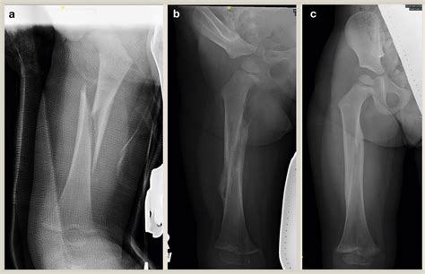 Non Accidental Injury Femoral Shaft And Neck Fractures In Children