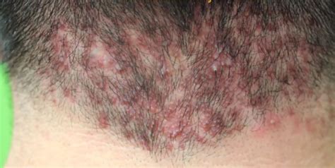 Small Red Itchy Pimples On Scalp Cause And Treatment Skincarederm