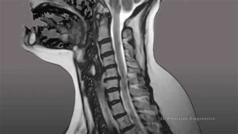 Cervical Spine Mri Bulged Disc
