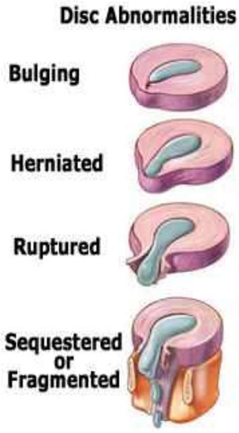 Herniated Circles At Times Oblige Surgery And Can As A Not Exactly