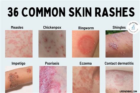Types Of Skin Rashes On Face Printable Templates Protal