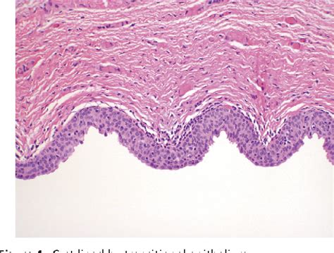Figure 6 From Vaginal Cysts A Pathology Review Semantic Scholar