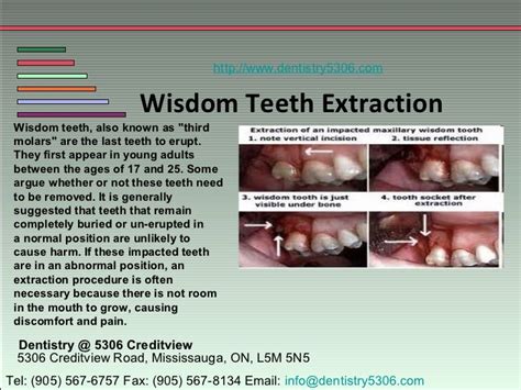 Dentist For Wisdom Teeth Extraction Emergency Service