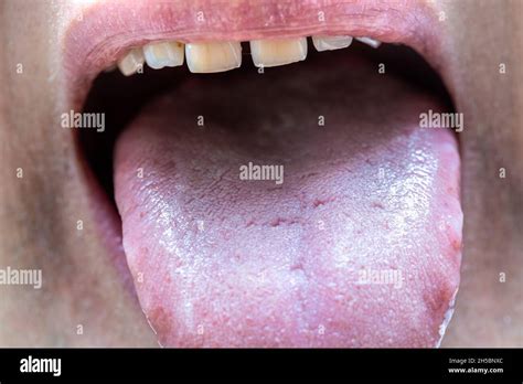 Tongue Pulled Out Of The Mouth Health Assessment And Oral Examination