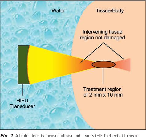 Figure 1 From Investigation Of Thermal Effect By Focused Ultrasound In