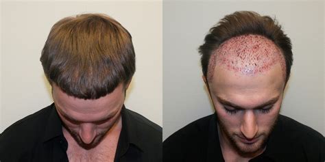 Root Components Of Hair Transplant Some Challenges Now Audi Shusar