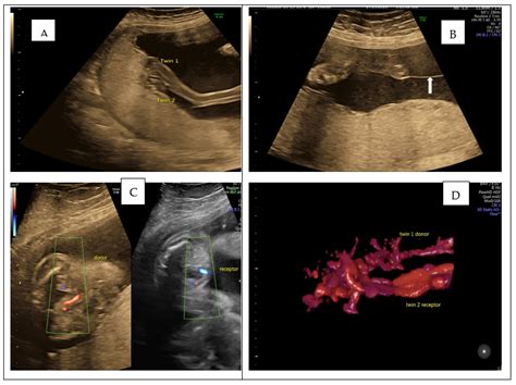 diagnostics free full text monochorionic diamniotic twins with bordering cord insertions