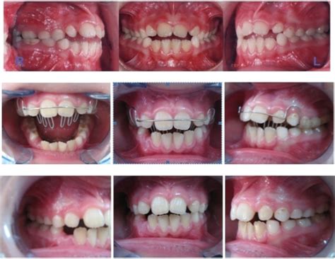 Figure 2prevention Perspective In Orthodontics And Dentofacial
