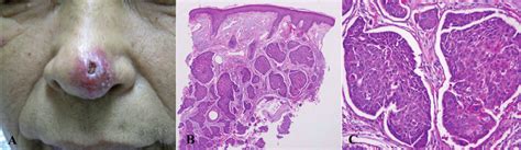 A Round Erythematous Painless Nodule With A Central Ulcer On The
