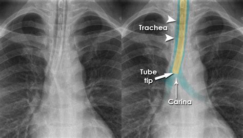 Chest X Ray Tubes Et Tubes Complications